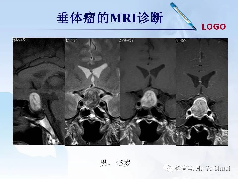 影像PPT - 【PPT】鞍区肿瘤的MRI诊断-13