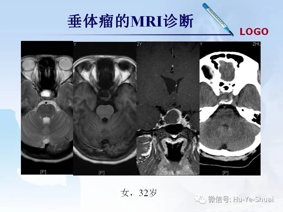 影像PPT - 【PPT】鞍区肿瘤的MRI诊断-14