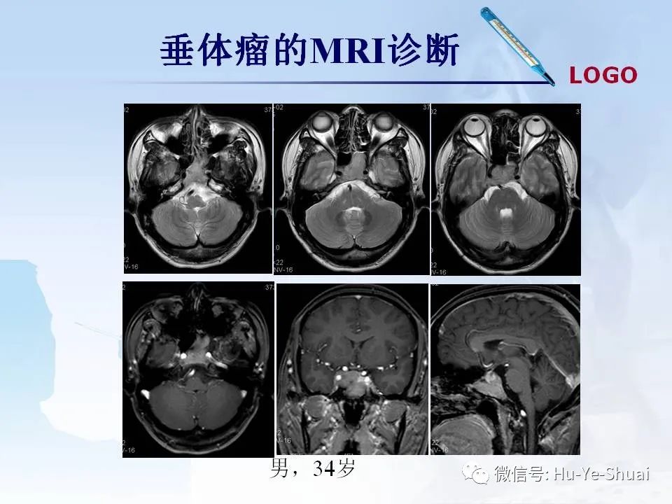影像PPT - 【PPT】鞍区肿瘤的MRI诊断-15