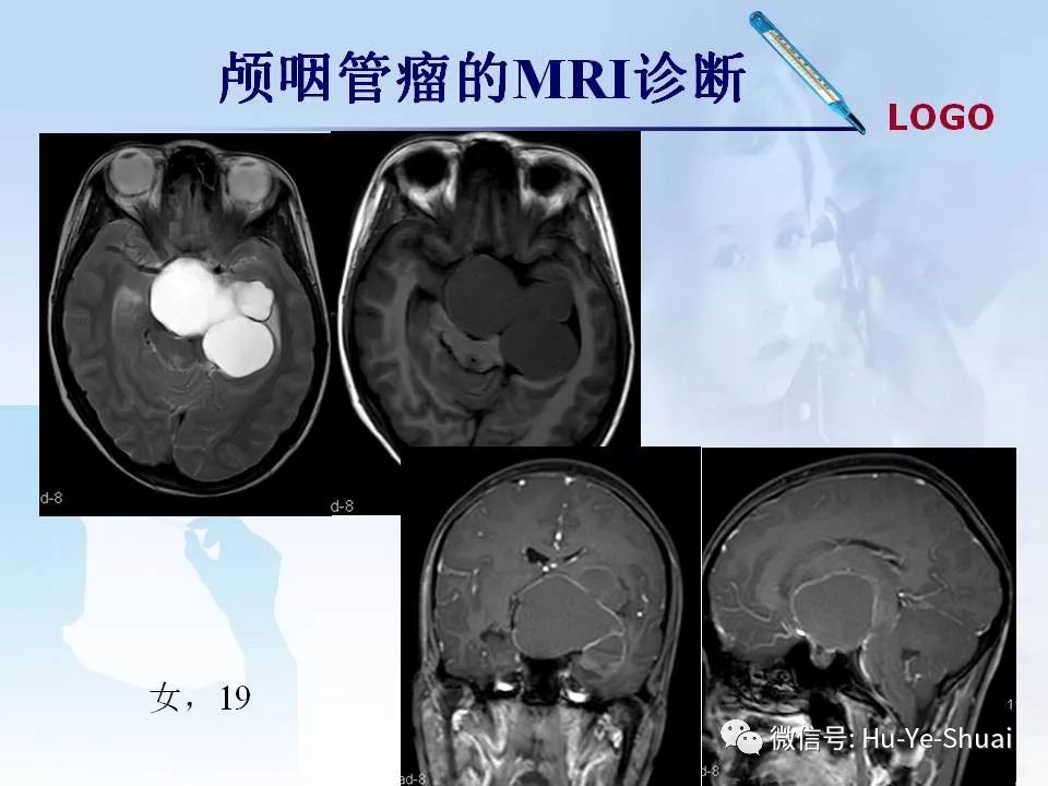 影像PPT - 【PPT】鞍区肿瘤的MRI诊断-19