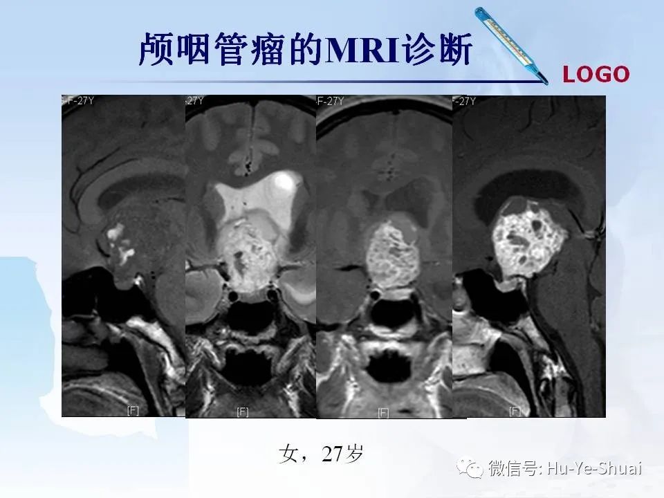 影像PPT - 【PPT】鞍区肿瘤的MRI诊断-18