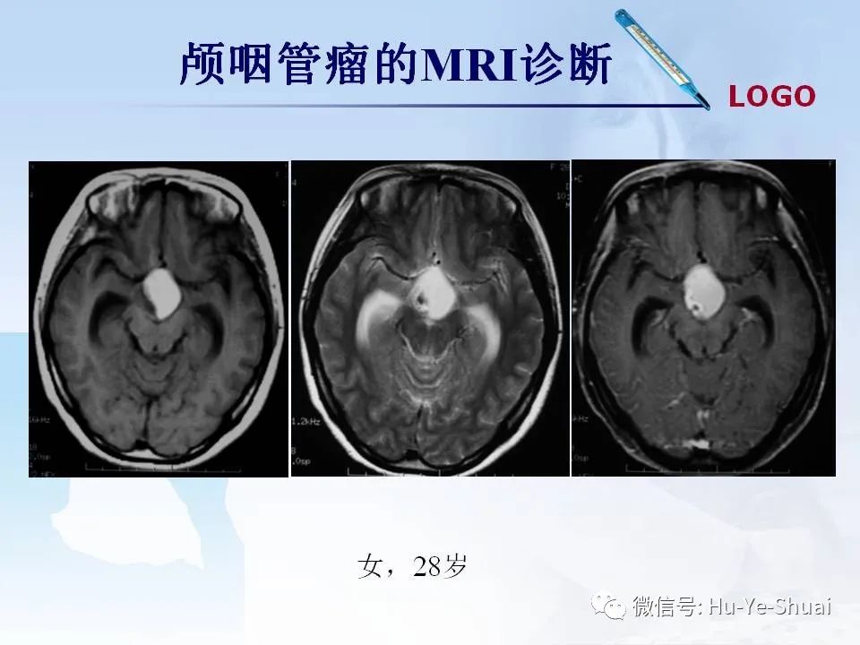 影像PPT - 【PPT】鞍区肿瘤的MRI诊断-20