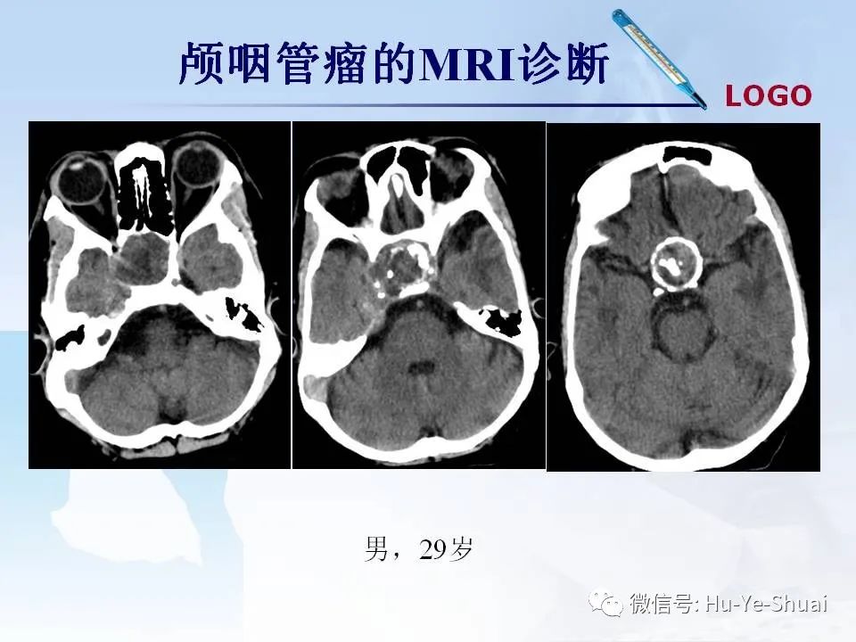 影像PPT - 【PPT】鞍区肿瘤的MRI诊断-21