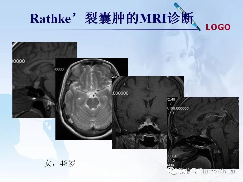 影像PPT - 【PPT】鞍区肿瘤的MRI诊断-23