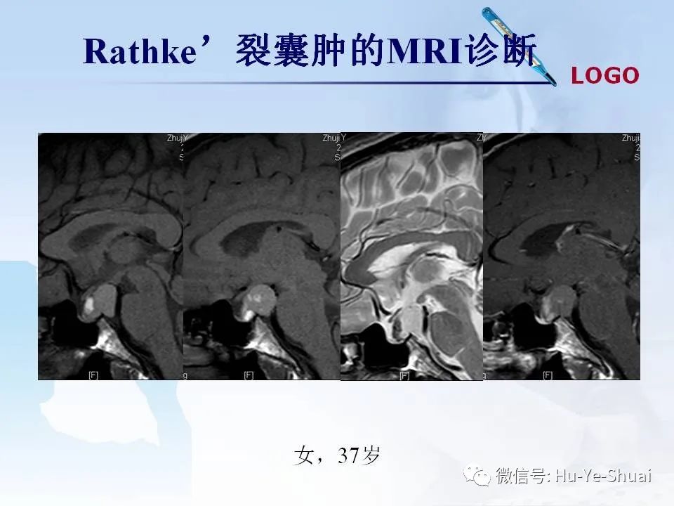 影像PPT - 【PPT】鞍区肿瘤的MRI诊断-24