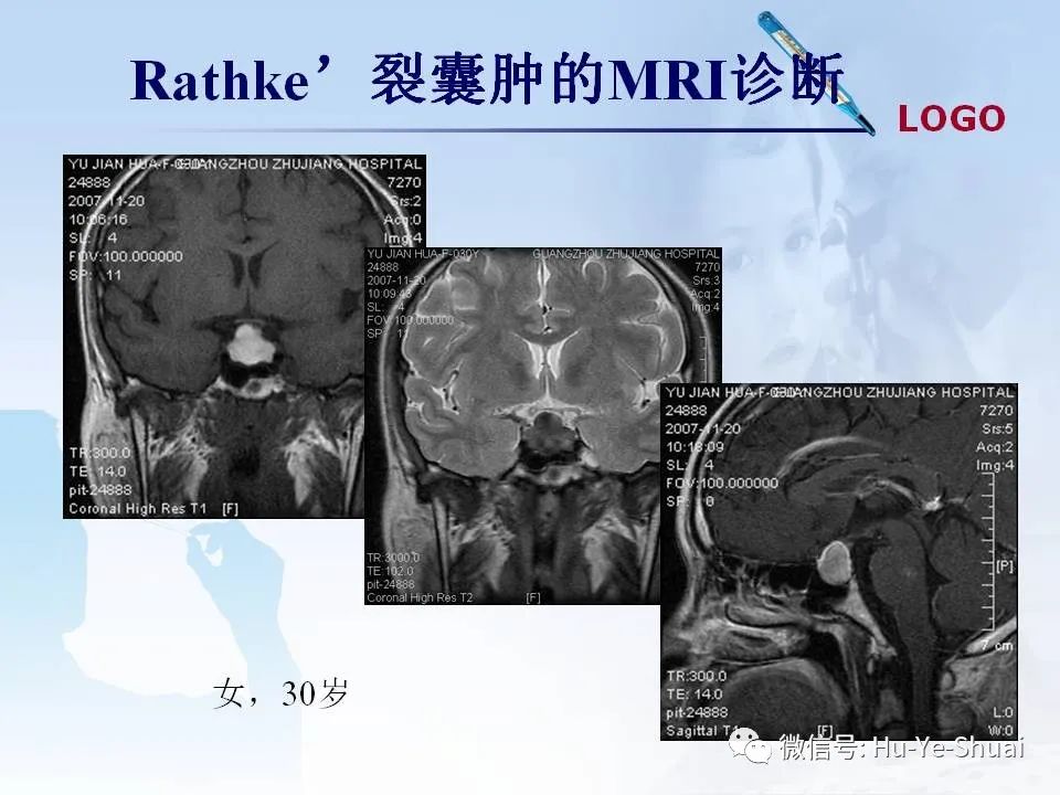 影像PPT - 【PPT】鞍区肿瘤的MRI诊断-25