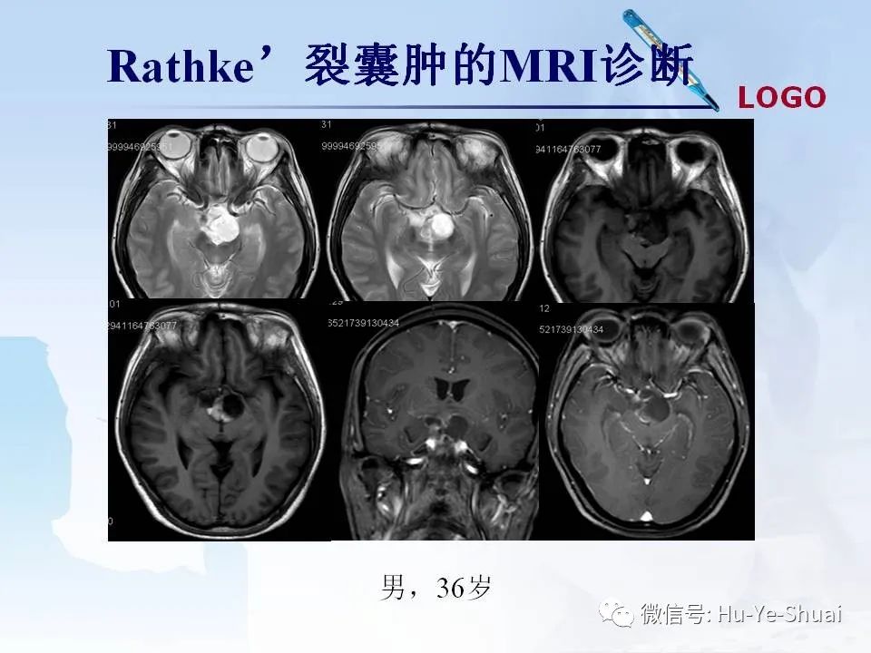 影像PPT - 【PPT】鞍区肿瘤的MRI诊断-26