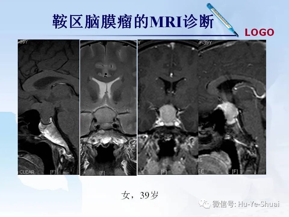 影像PPT - 【PPT】鞍区肿瘤的MRI诊断-28