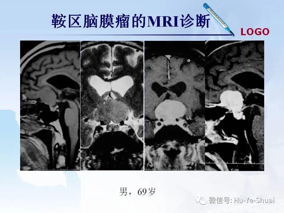 影像PPT - 【PPT】鞍区肿瘤的MRI诊断-29