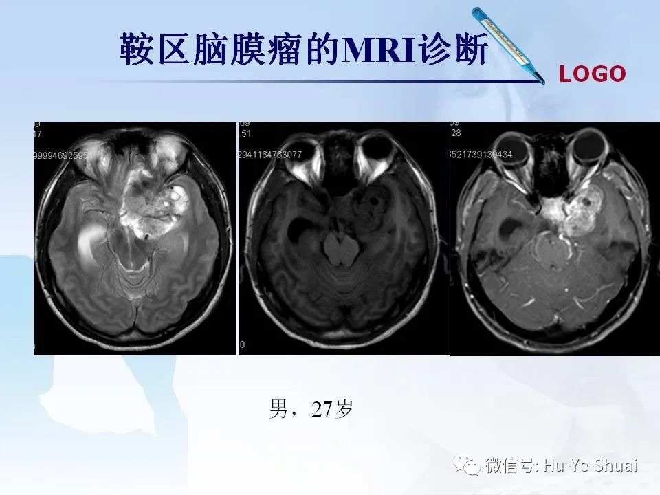 影像PPT - 【PPT】鞍区肿瘤的MRI诊断-31