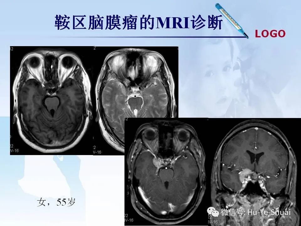 影像PPT - 【PPT】鞍区肿瘤的MRI诊断-30