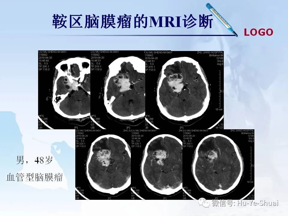 影像PPT - 【PPT】鞍区肿瘤的MRI诊断-32