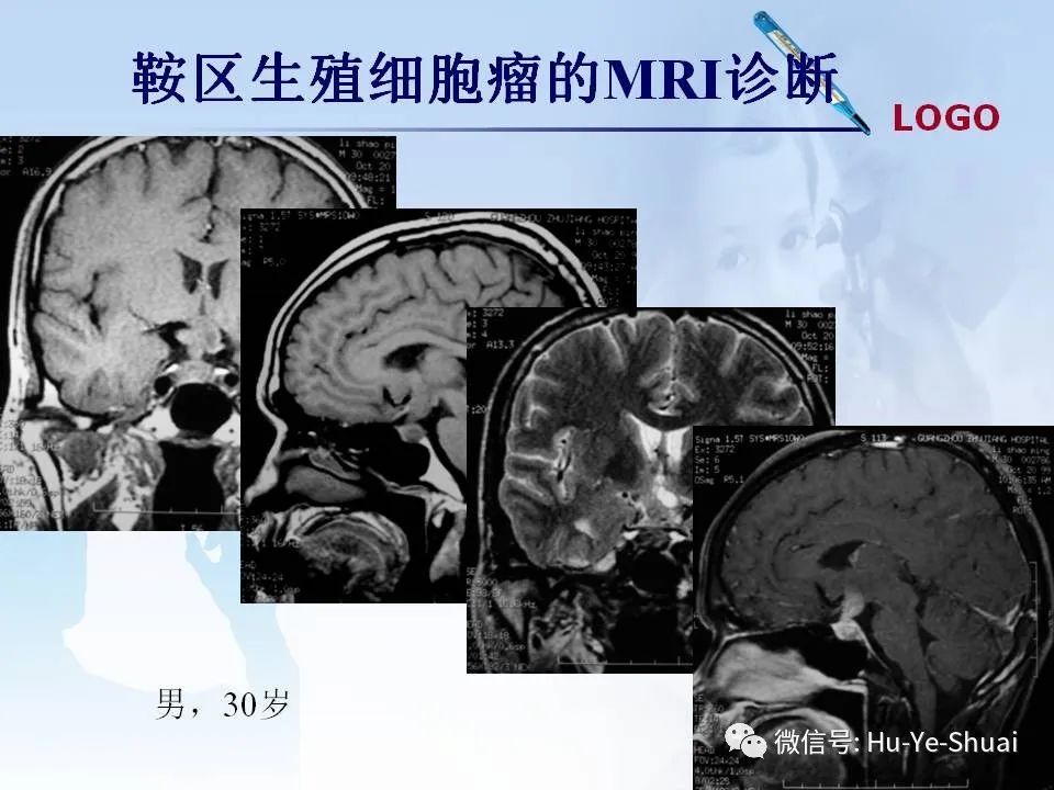 影像PPT - 【PPT】鞍区肿瘤的MRI诊断-35
