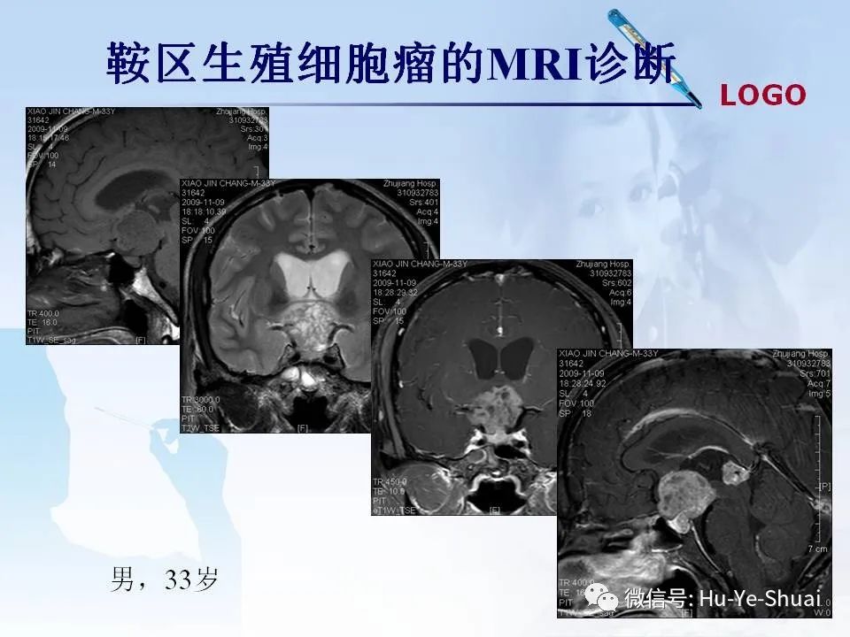 影像PPT - 【PPT】鞍区肿瘤的MRI诊断-37