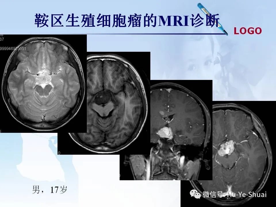 影像PPT - 【PPT】鞍区肿瘤的MRI诊断-36