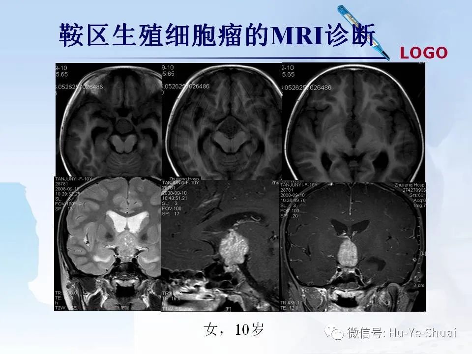 影像PPT - 【PPT】鞍区肿瘤的MRI诊断-38
