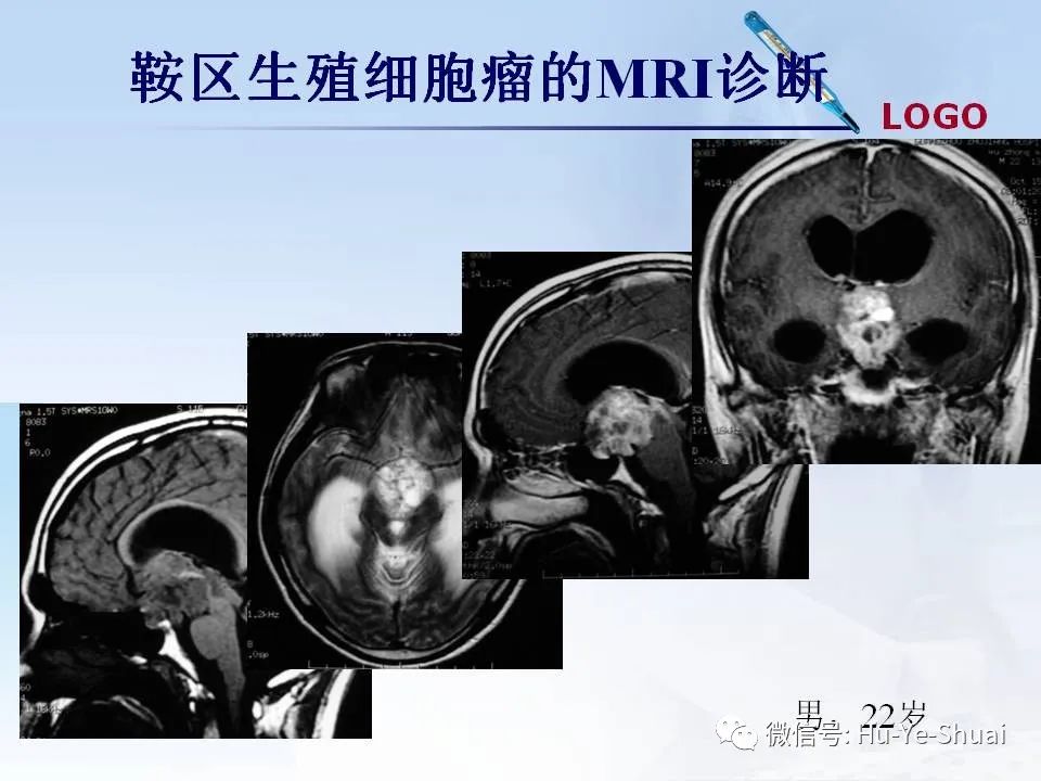 影像PPT - 【PPT】鞍区肿瘤的MRI诊断-39