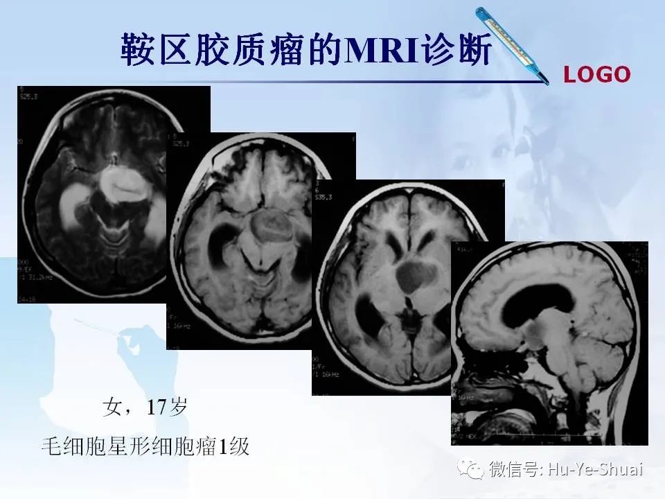 影像PPT - 【PPT】鞍区肿瘤的MRI诊断-42
