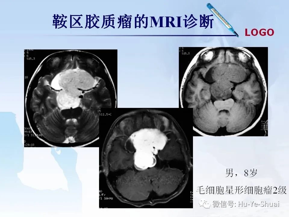 影像PPT - 【PPT】鞍区肿瘤的MRI诊断-43
