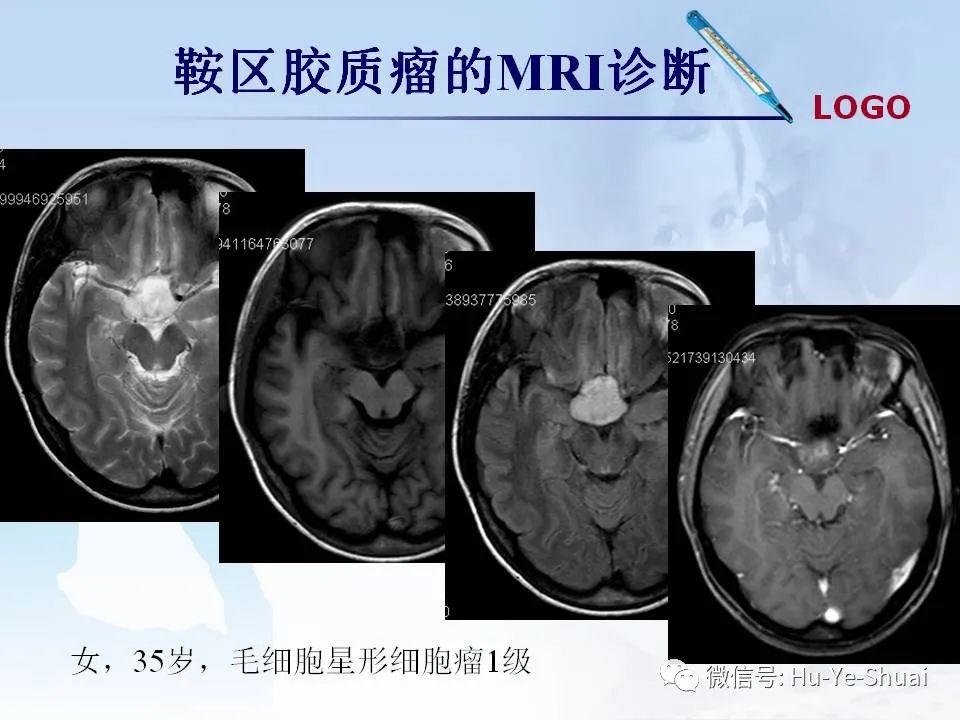 影像PPT - 【PPT】鞍区肿瘤的MRI诊断-44