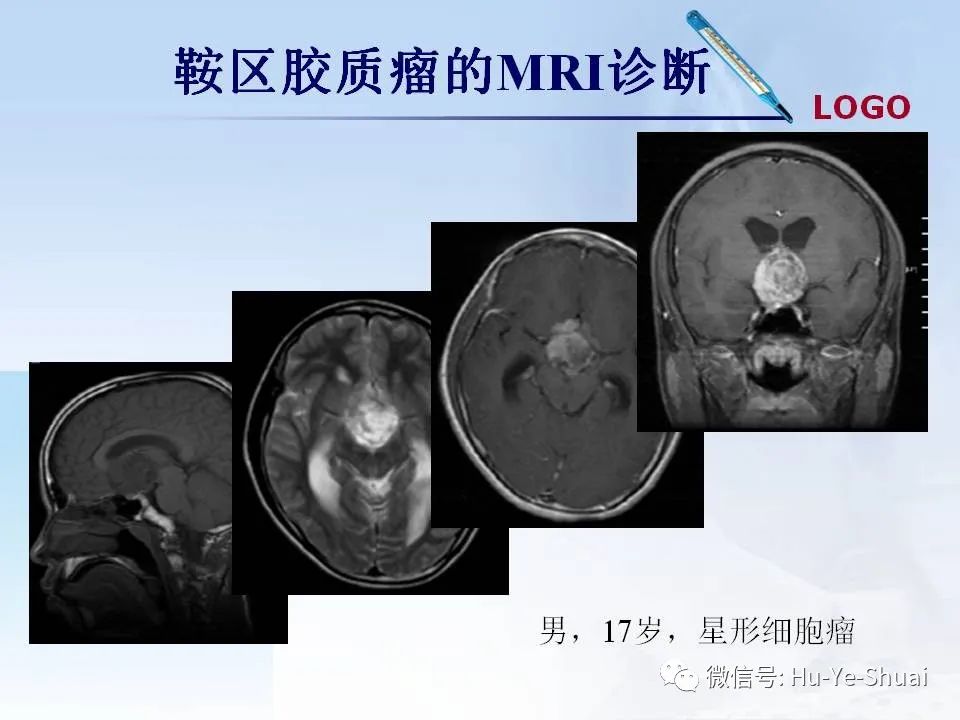 影像PPT - 【PPT】鞍区肿瘤的MRI诊断-45