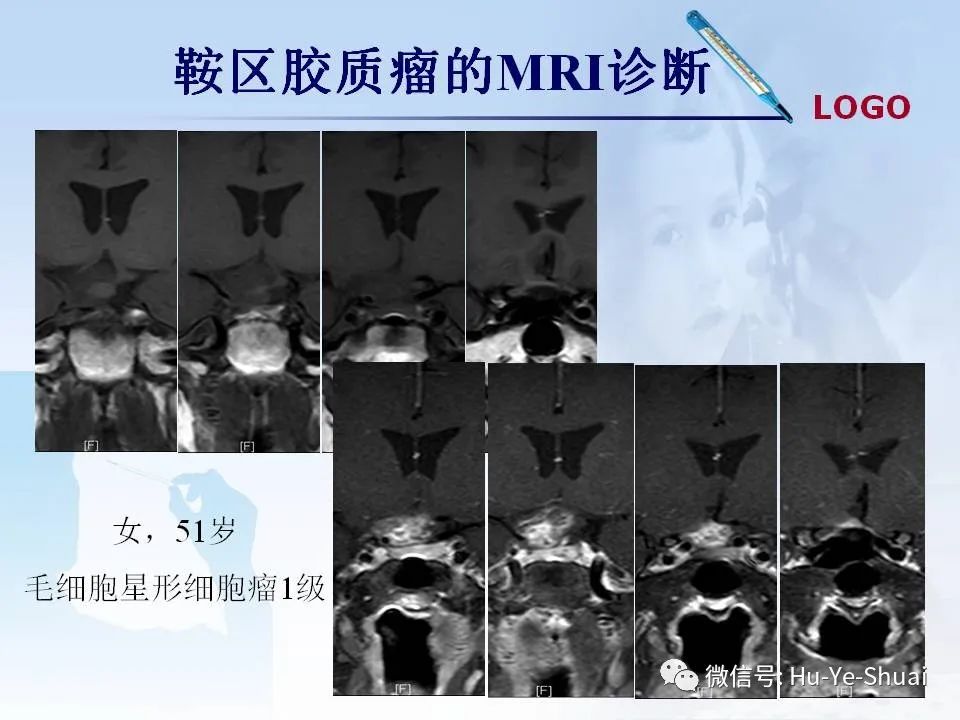 影像PPT - 【PPT】鞍区肿瘤的MRI诊断-46