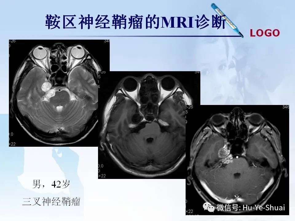 影像PPT - 【PPT】鞍区肿瘤的MRI诊断-50