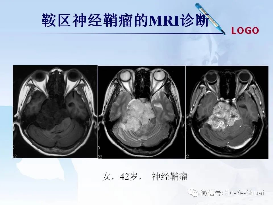 影像PPT - 【PPT】鞍区肿瘤的MRI诊断-51