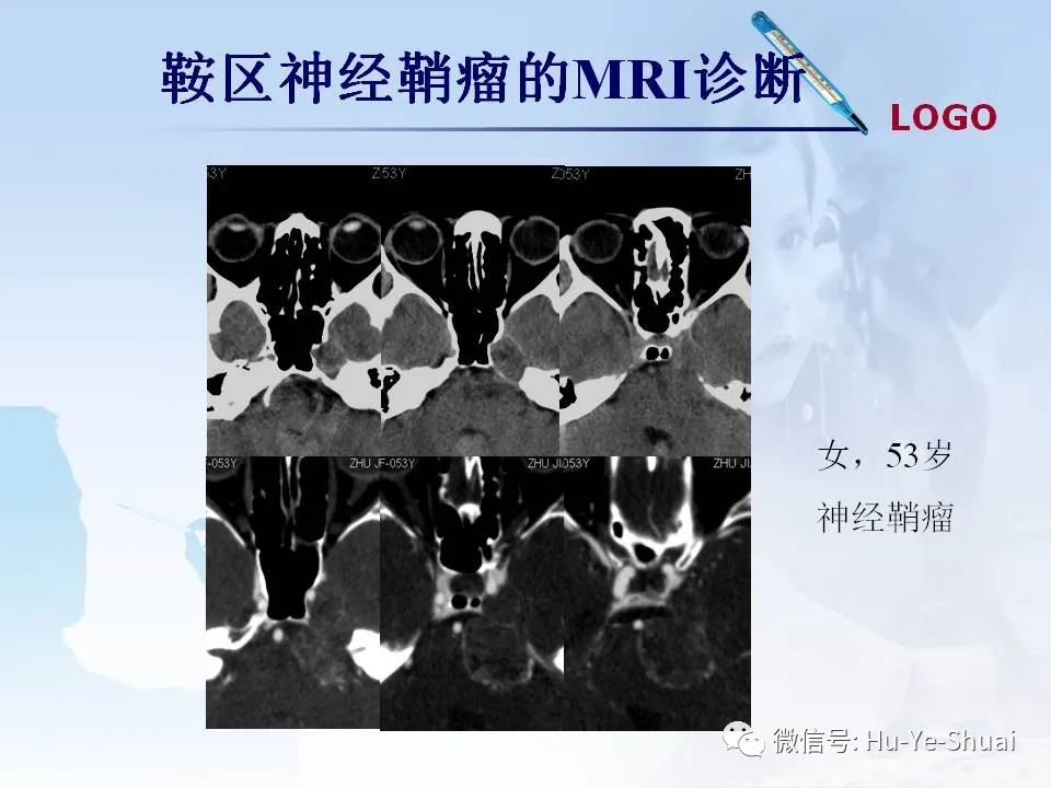 影像PPT - 【PPT】鞍区肿瘤的MRI诊断-52