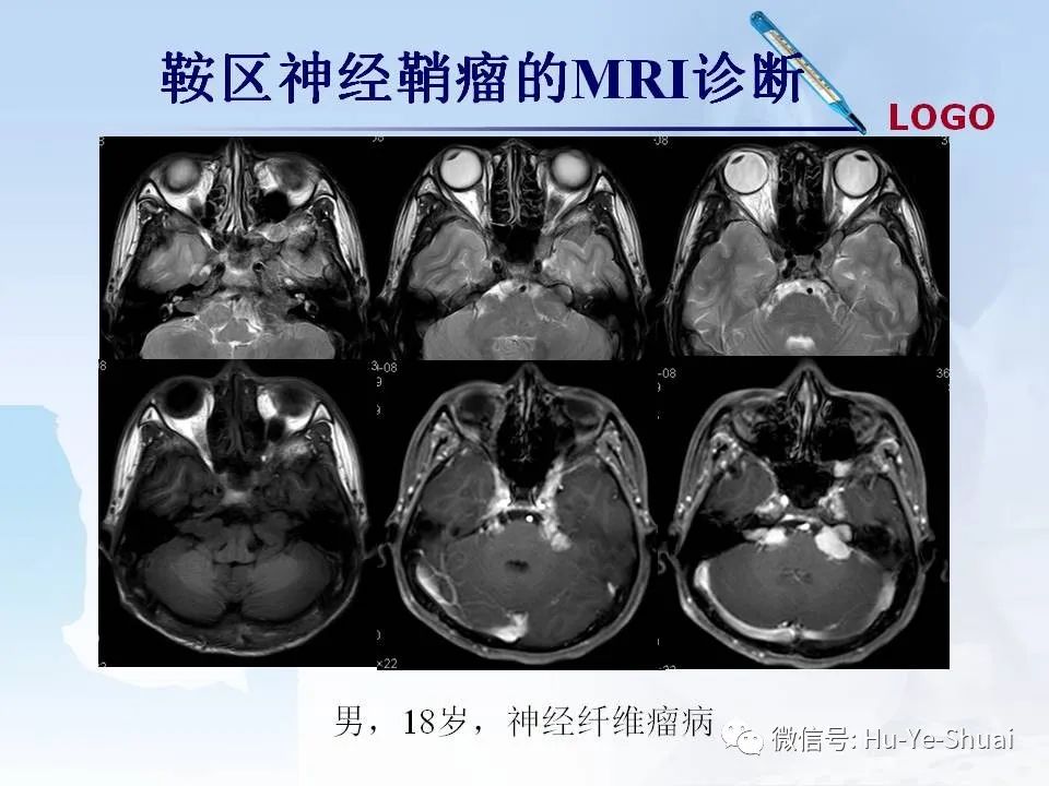 影像PPT - 【PPT】鞍区肿瘤的MRI诊断-54