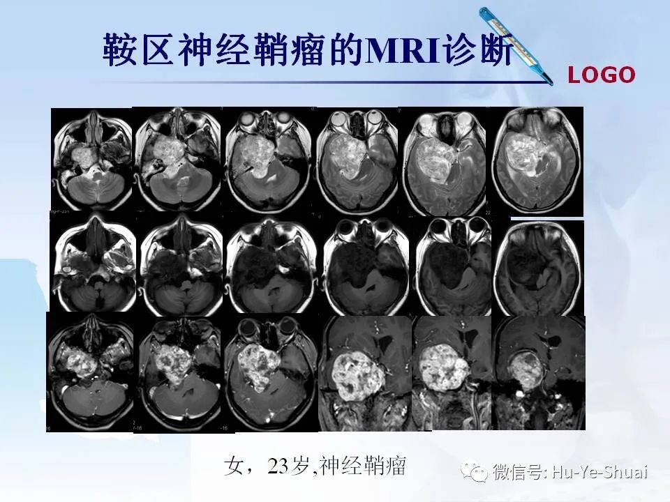 影像PPT - 【PPT】鞍区肿瘤的MRI诊断-53