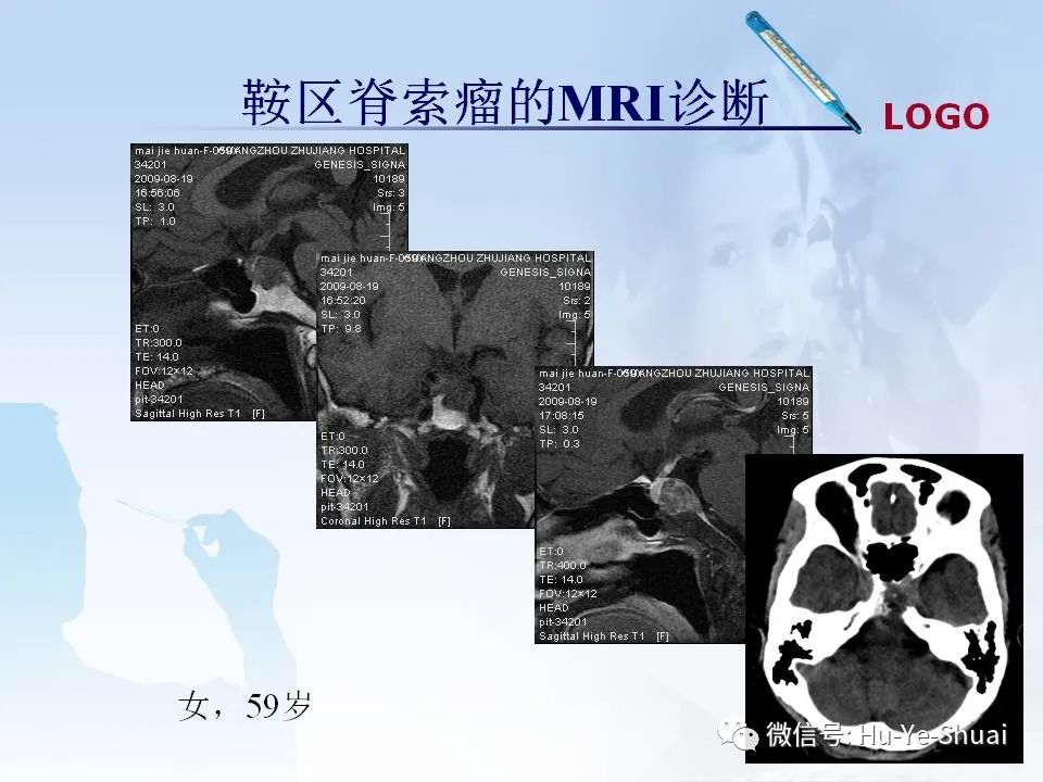 影像PPT - 【PPT】鞍区肿瘤的MRI诊断-56