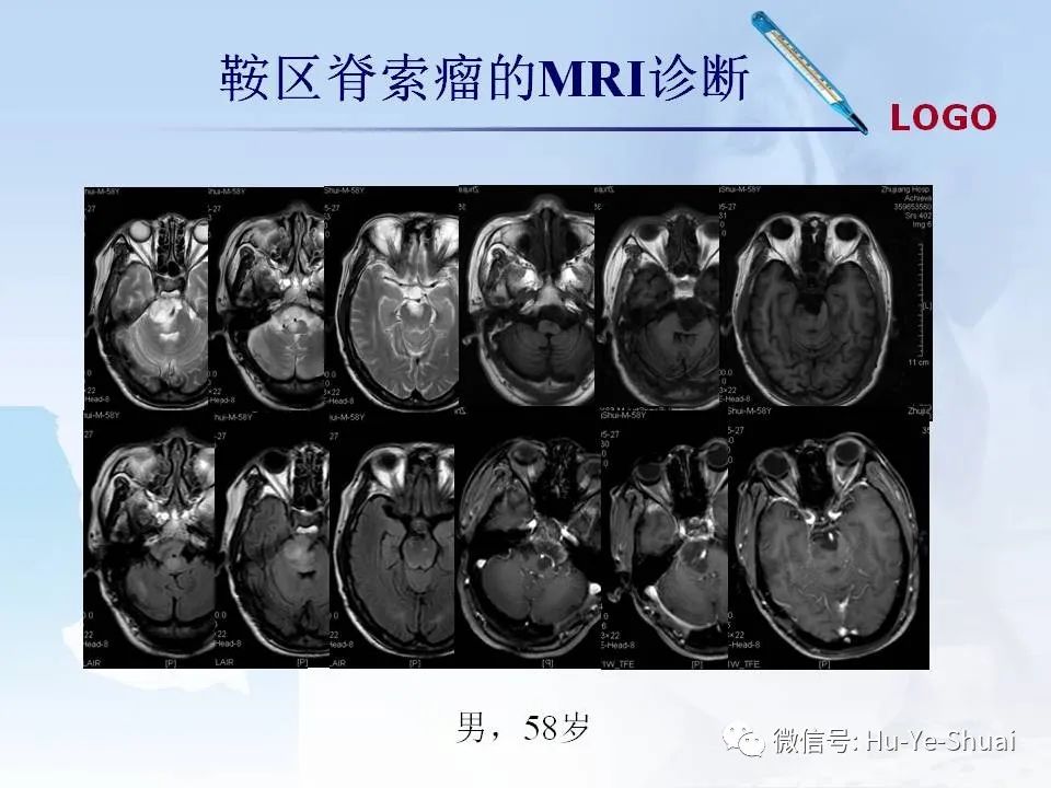 影像PPT - 【PPT】鞍区肿瘤的MRI诊断-57