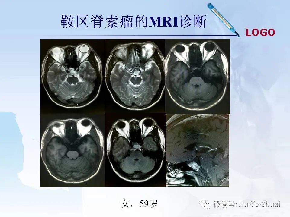 影像PPT - 【PPT】鞍区肿瘤的MRI诊断-58