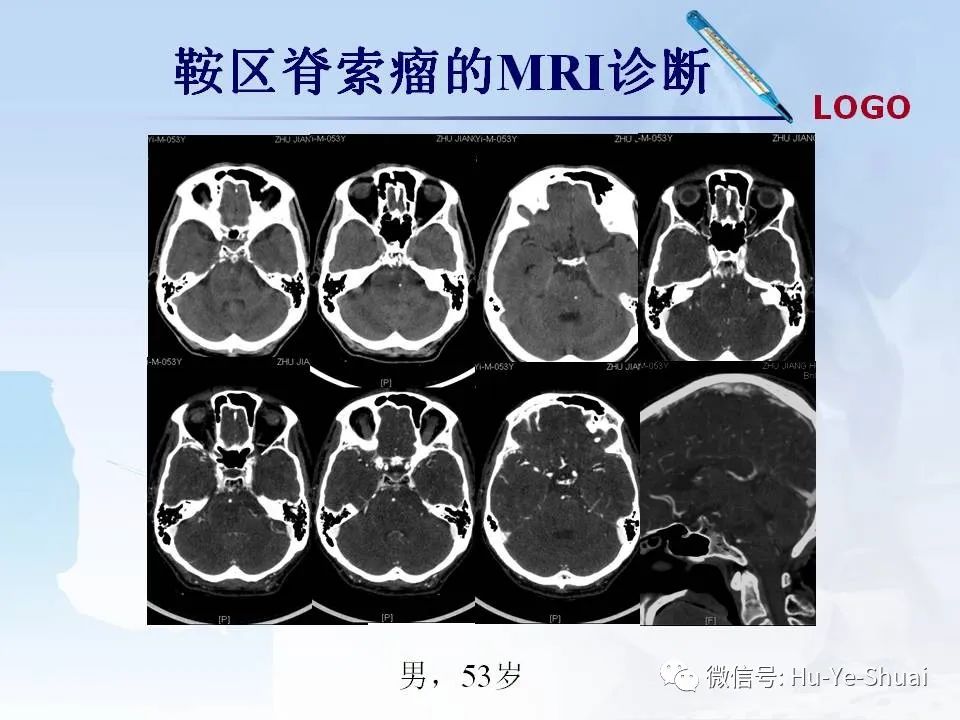 影像PPT - 【PPT】鞍区肿瘤的MRI诊断-59