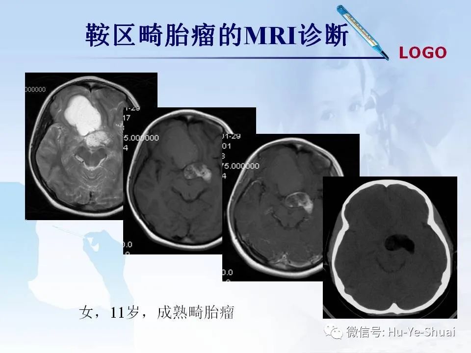 影像PPT - 【PPT】鞍区肿瘤的MRI诊断-62