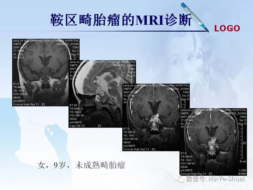 影像PPT - 【PPT】鞍区肿瘤的MRI诊断-63