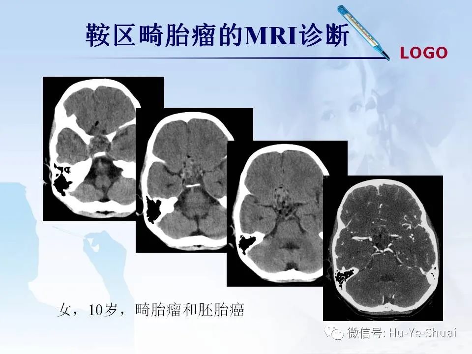 影像PPT - 【PPT】鞍区肿瘤的MRI诊断-64