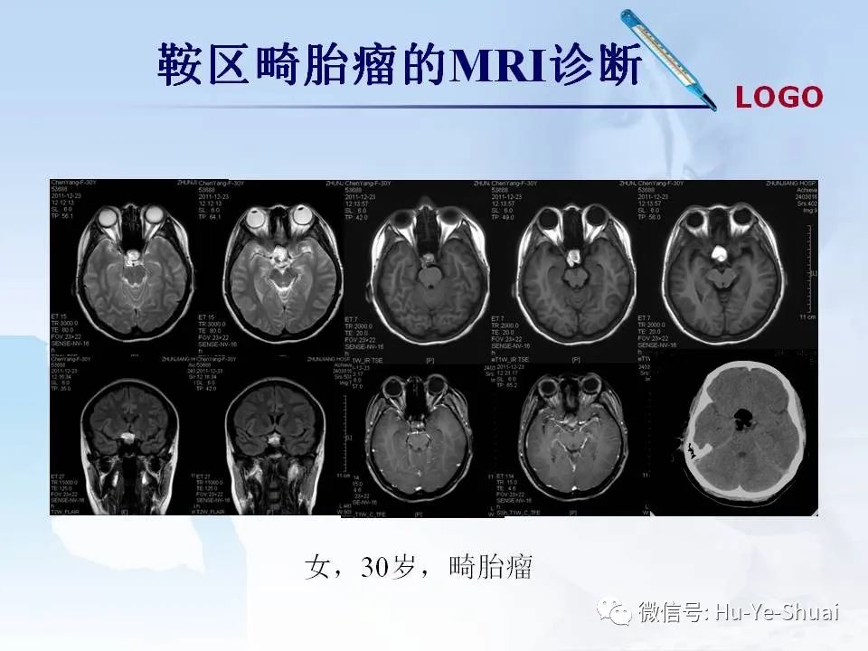 影像PPT - 【PPT】鞍区肿瘤的MRI诊断-65