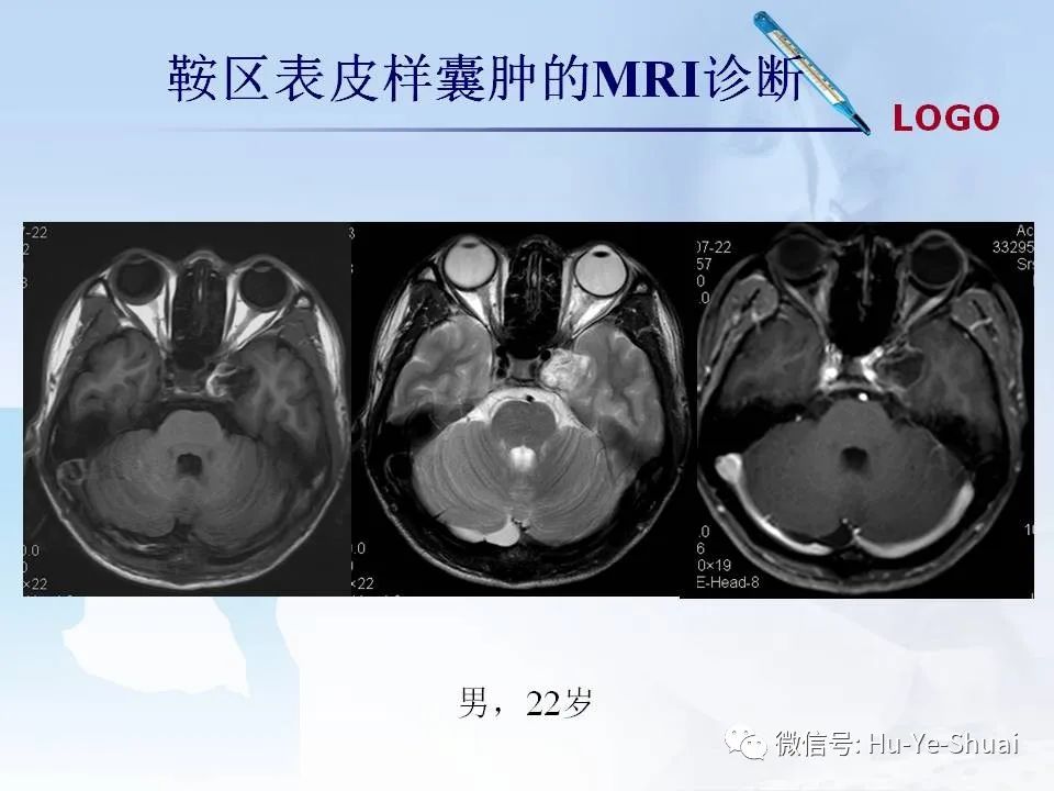 影像PPT - 【PPT】鞍区肿瘤的MRI诊断-67