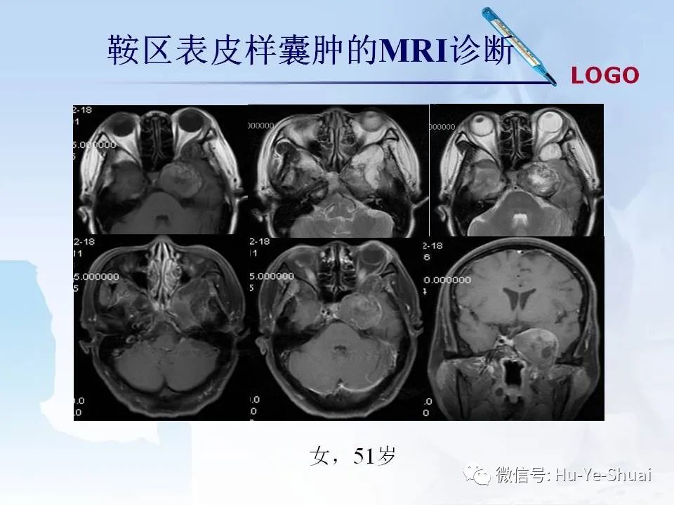 影像PPT - 【PPT】鞍区肿瘤的MRI诊断-68