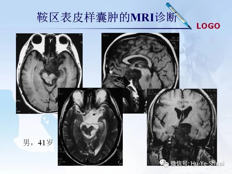 影像PPT - 【PPT】鞍区肿瘤的MRI诊断-69