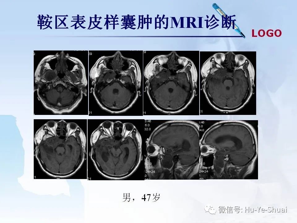 影像PPT - 【PPT】鞍区肿瘤的MRI诊断-70
