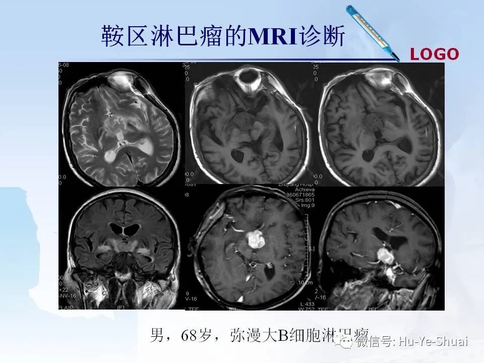 影像PPT - 【PPT】鞍区肿瘤的MRI诊断-72