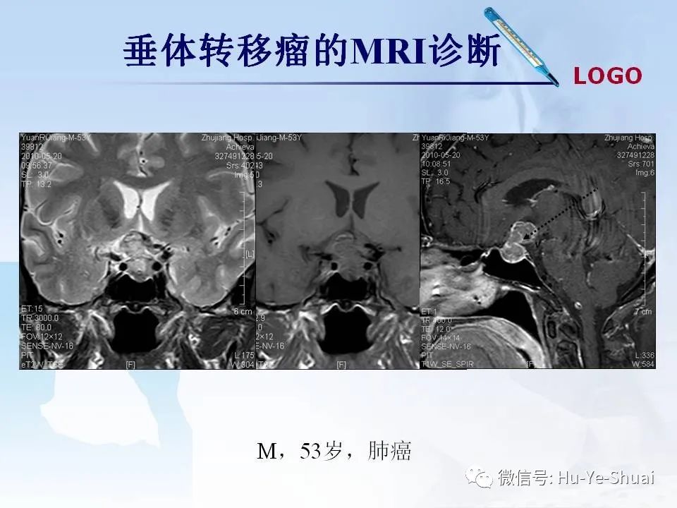 影像PPT - 【PPT】鞍区肿瘤的MRI诊断-74