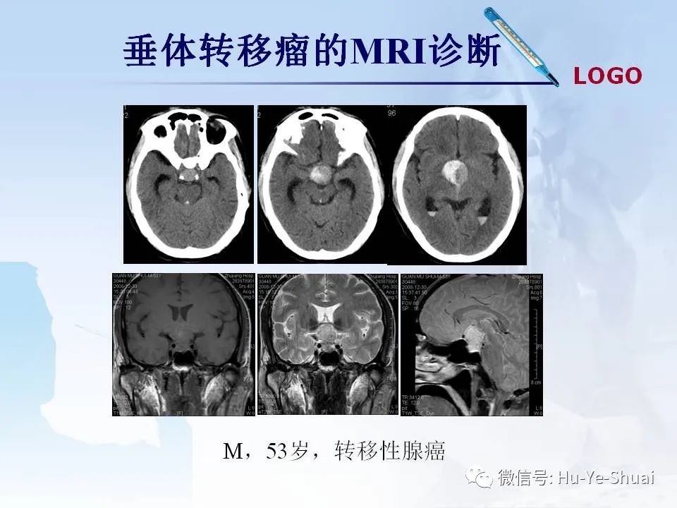 影像PPT - 【PPT】鞍区肿瘤的MRI诊断-75