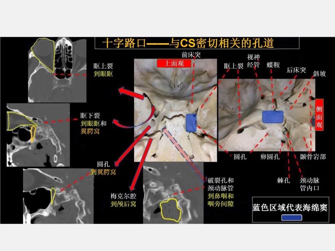 影像PPT - 【PPT】中枢神经系统血管病变—海绵窦影像病理对照-6