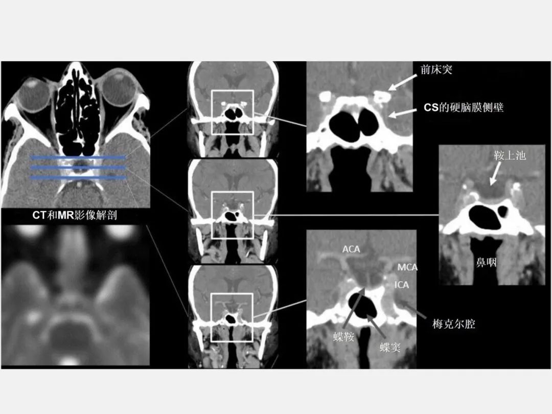 影像PPT - 【PPT】中枢神经系统血管病变—海绵窦影像病理对照-7