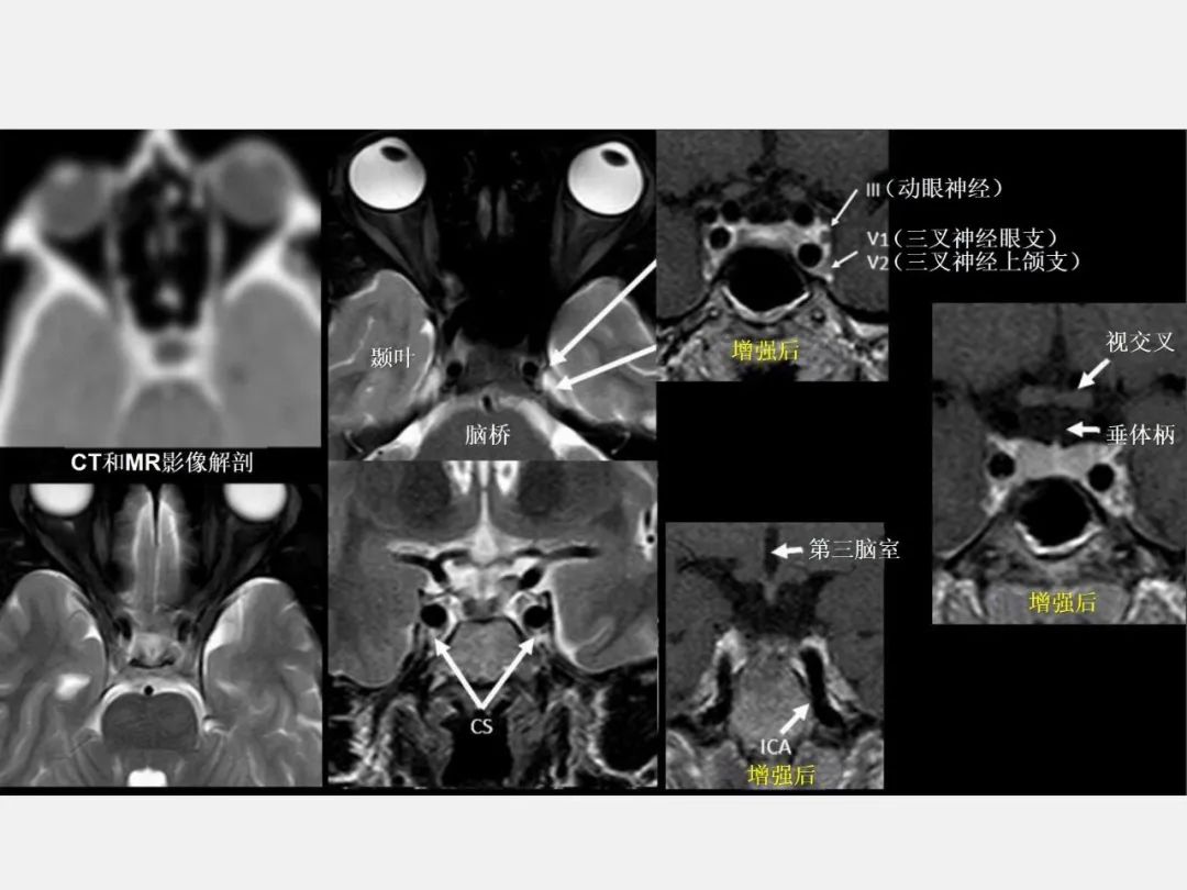 影像PPT - 【PPT】中枢神经系统血管病变—海绵窦影像病理对照-9