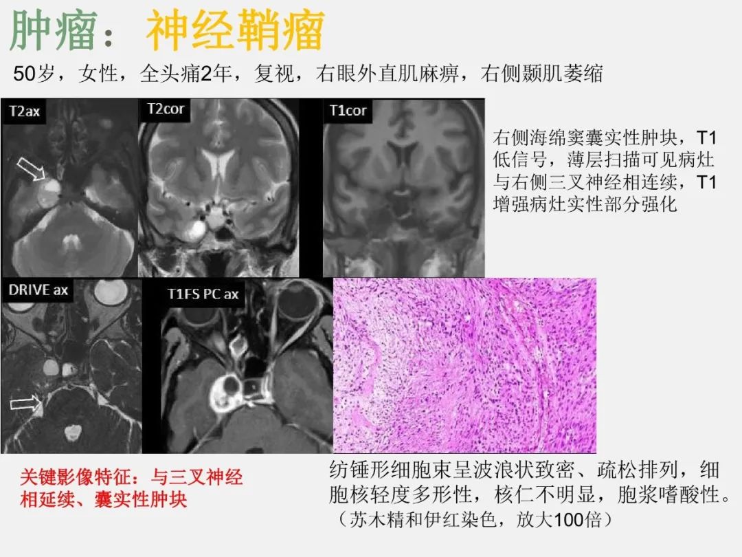 影像PPT - 【PPT】中枢神经系统血管病变—海绵窦影像病理对照-12